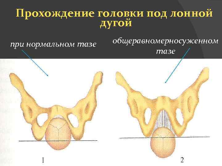  Прохождение головки под лонной дугой при нормальном тазе общеравномерносуженном тазе 