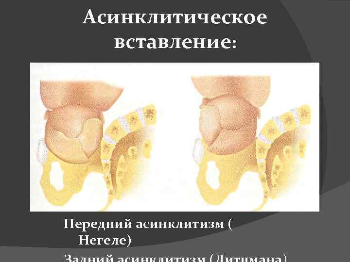 Асинклитическое вставление: Передний асинклитизм ( Негеле) 