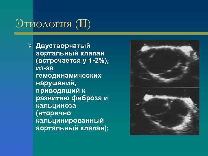 Этиология (II) Ø Двустворчатый аортальный клапан (встречается у 1 -2%), из-за гемодинамических нарушений, приводящий