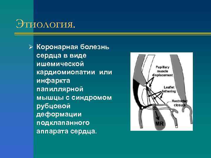 Этиология. Ø Коронарная болезнь сердца в виде ишемической кардиомиопатии или инфаркта папиллярной мышцы с