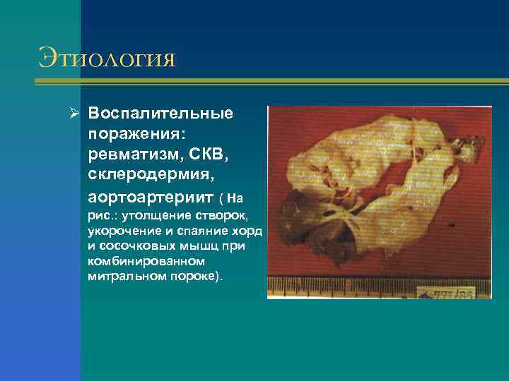 Этиология Ø Воспалительные поражения: ревматизм, СКВ, склеродермия, аортоартериит ( На рис. : утолщение створок,