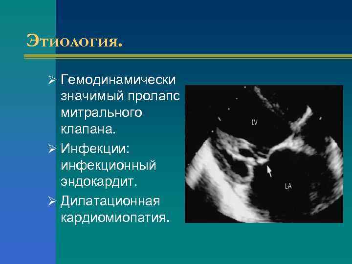 Этиология. Ø Гемодинамически значимый пролапс митрального клапана. Ø Инфекции: инфекционный эндокардит. Ø Дилатационная кардиомиопатия.