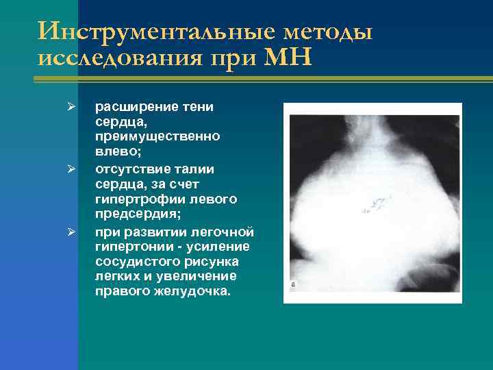 Инструментальные методы исследования при МН Ø Ø Ø расширение тени сердца, преимущественно влево; отсутствие