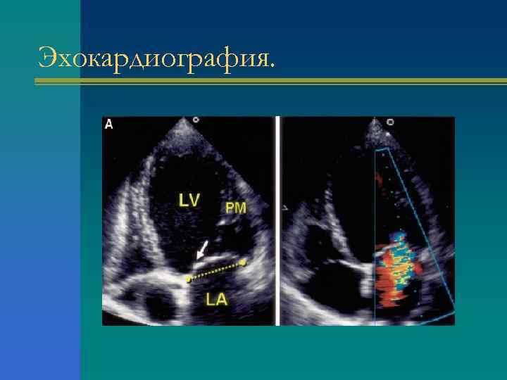 Эхокардиография. 