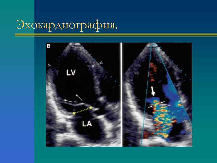 Эхокардиография. 