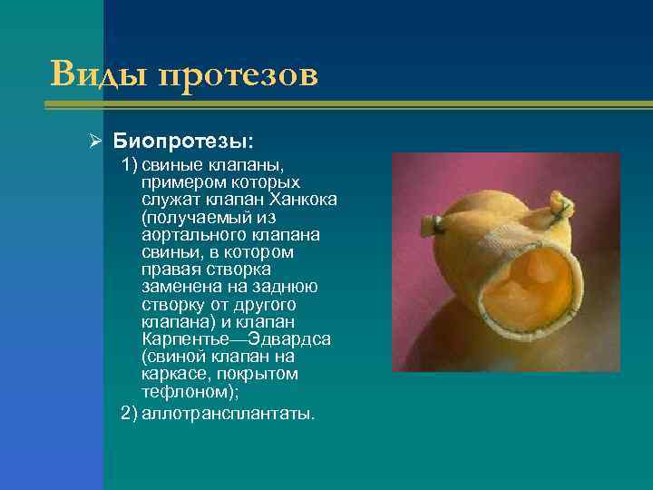 Виды протезов Ø Биопротезы: 1) свиные клапаны, примером которых служат клапан Ханкока (получаемый из