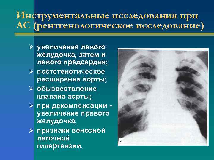 Инструментальные исследования при АС (рентгенологическое исследование) Ø увеличение левого Ø Ø желудочка, затем и