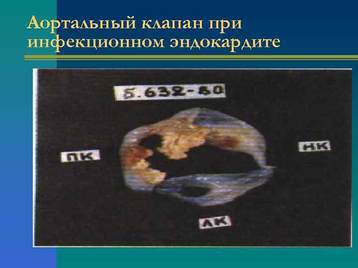 Аортальный клапан при инфекционном эндокардите 