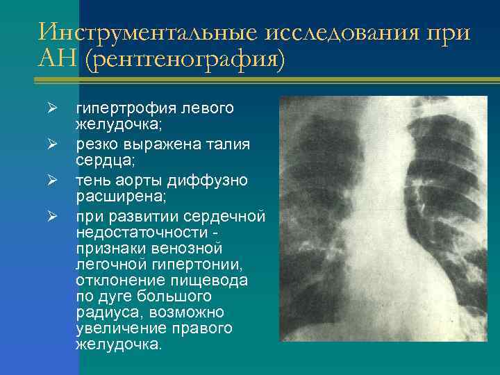 Инструментальные исследования при АН (рентгенография) Ø Ø гипертрофия левого желудочка; резко выражена талия сердца;