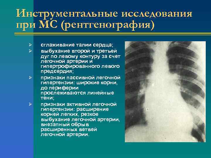 Инструментальные исследования при МС (рентгенография) Ø Ø сглаживание талии сердца; выбухание второй и третьей