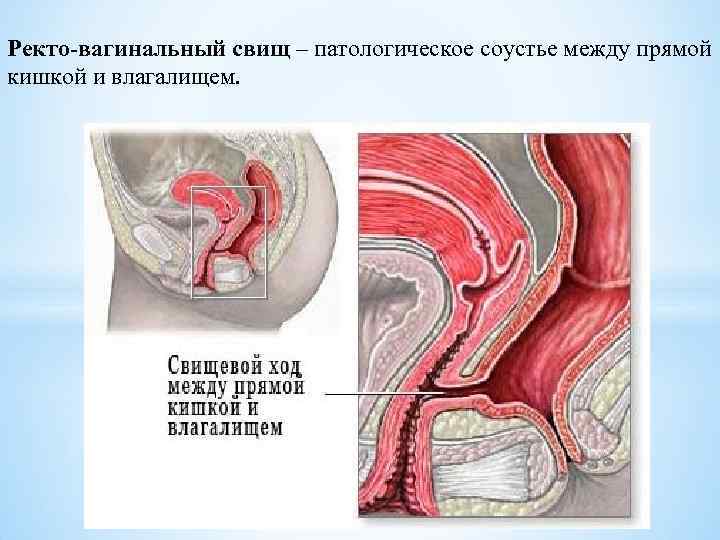 Ректо-вагинальный свищ – патологическое соустье между прямой кишкой и влагалищем. 