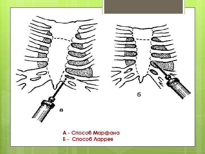 А - Способ Марфана Б - Способ Ларрея 
