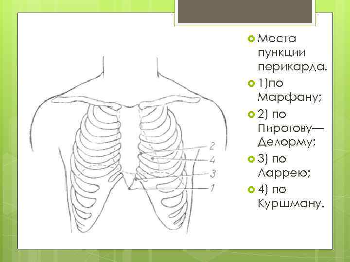  Места пункции перикарда. 1)по Марфану; 2) по Пирогову— Делорму; 3) по Ларрею; 4)