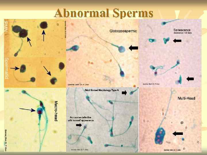 Abnormal Sperms 