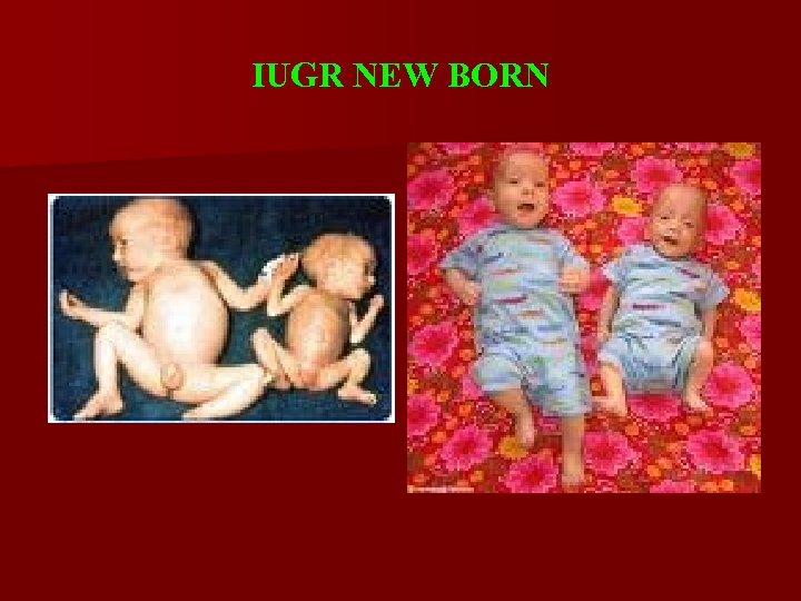 IUGR NEW BORN 