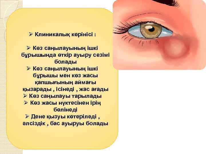 Ø Клиникалық көрінісі : Ø Көз саңылауының ішкі бұрышында өткір ауыру сезімі болады Ø