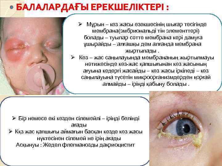  БАЛАЛАРДАҒЫ ЕРЕКШЕЛІКТЕРІ : Ø Мұрын – көз жасы өзекшесінің шығар тесігінде мембрана(эмбриональді тін