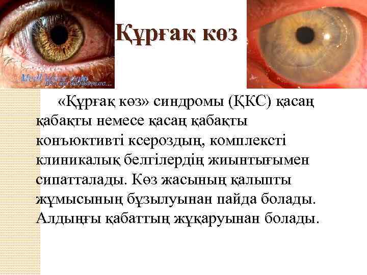 Құрғақ көз «Құрғақ көз» синдромы (ҚКС) қасаң қабақты немесе қасаң қабақты конъюктивті ксероздың, комплексті