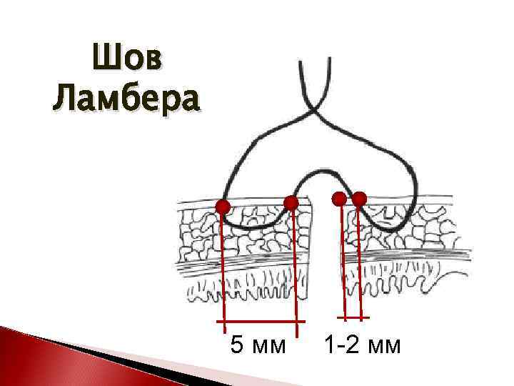 Шов Ламбера 5 мм 1 -2 мм 
