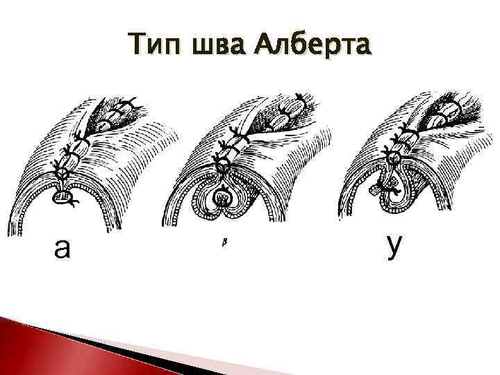Тип шва Алберта а у 