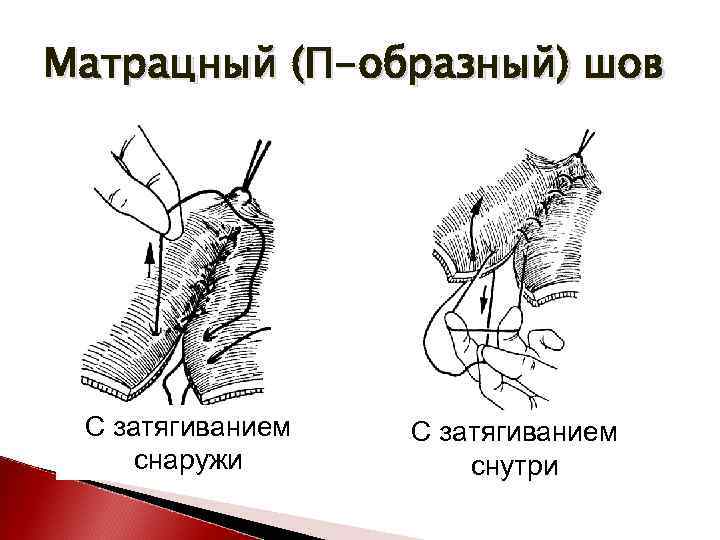 Матрацный (П-образный) шов С затягиванием снаружи С затягиванием снутри 