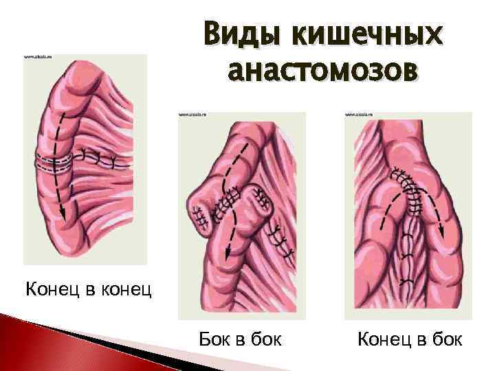 Кишечные анастомозы. Межкишечные анастомозы. Виды кишечных анастомозов. Кишечный анастомоз бок в бок. Кишечный анастомоз конец в бок.