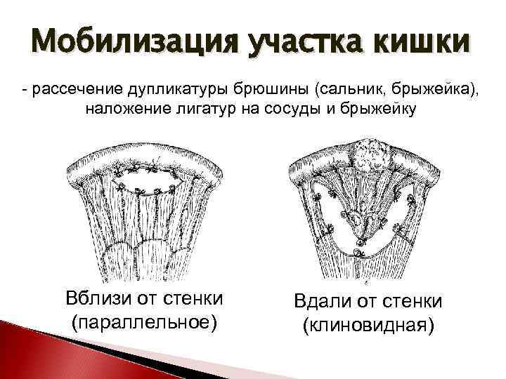 Схема мобилизации двенадцатиперстной кишки по кохеру линия рассечения