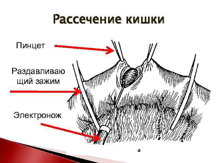 Рассечение кишки Пинцет Раздавливаю щий зажим Электронож 