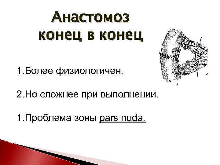 Анастомоз конец в конец 1. Более физиологичен. 2. Но сложнее при выполнении. 1. Проблема