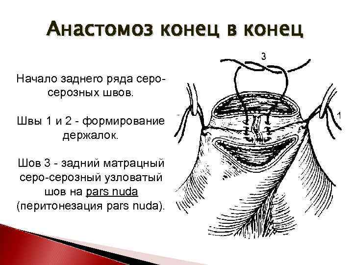 Анастомоз конец в конец схема