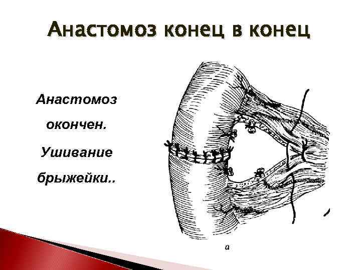 Анастомоз конец в конец схема