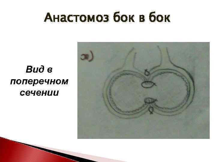 Анастомоз бок в бок Вид в поперечном сечении 