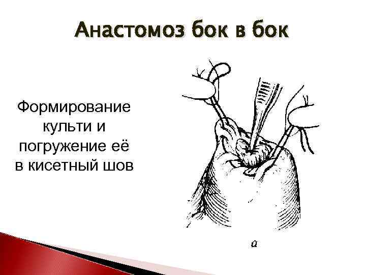 Анастомоз бок в бок Формирование культи и погружение её в кисетный шов 