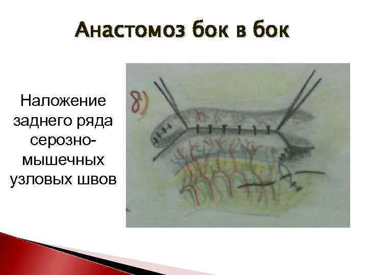 Анастомоз бок в бок Наложение заднего ряда серозномышечных узловых швов 