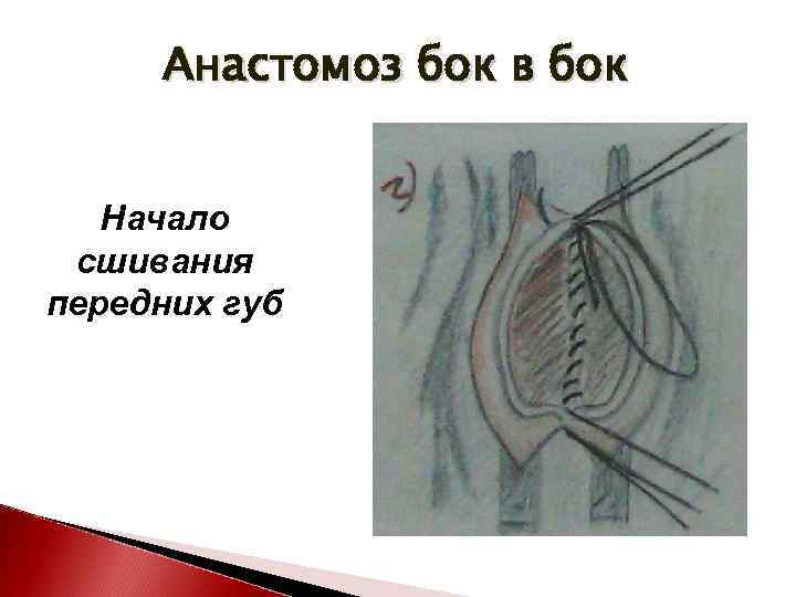 Анастомоз бок в бок Начало сшивания передних губ 