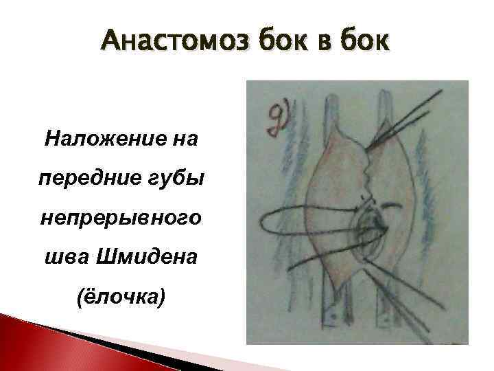 Анастомоз бок в бок Наложение на передние губы непрерывного шва Шмидена (ёлочка) 