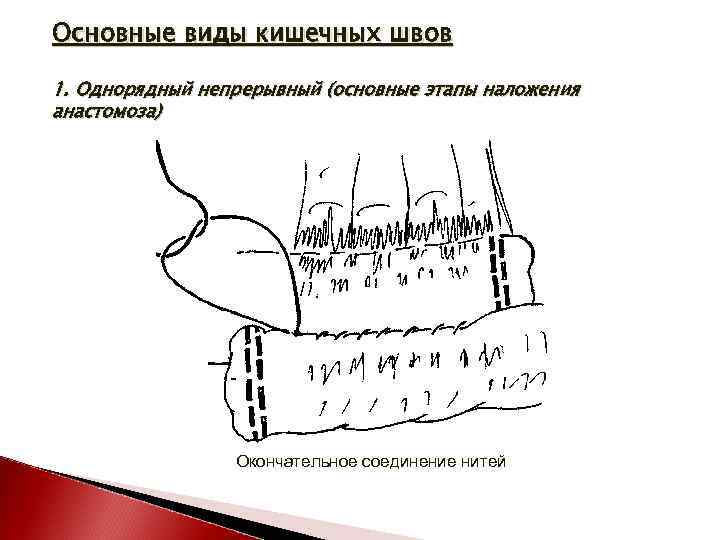 Кишечные швы топографическая анатомия