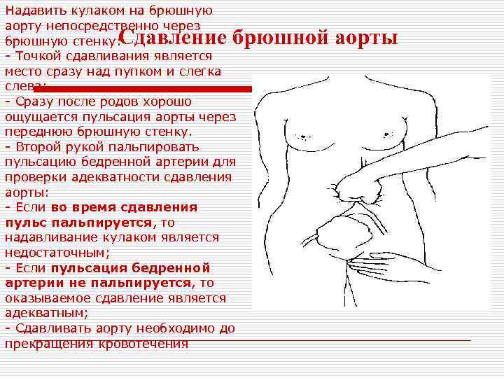 Надавить кулаком на брюшную аорту непосредственно через брюшную стенку: - Точкой сдавливания является место