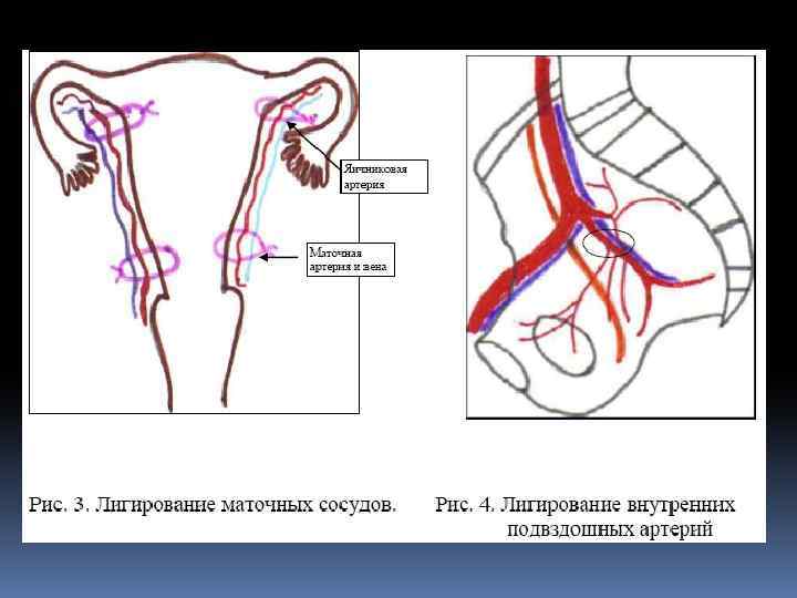 Сосуды матки. Перевязка внутренней подвздошной артерии. Перевязка маточных и внутренних подвздошных артерий. Перевязка внутренней подвздошной артерии техника. Перевязка ветвей маточной артерии.
