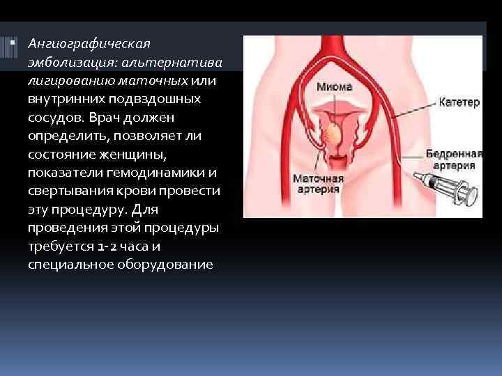 Эмболизация маточных артерий фото