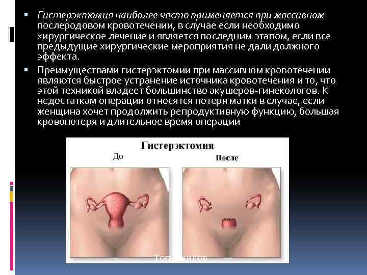  Гистерэктомия наиболее часто применяется при массивном послеродовом кровотечении, в случае если необходимо хирургическое