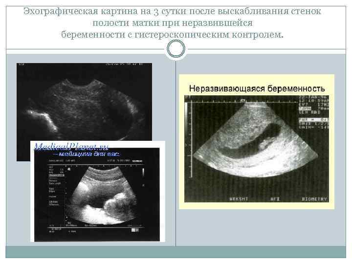 Эхографическая картина на 3 сутки после выскабливания стенок полости матки при неразвившейся беременности с