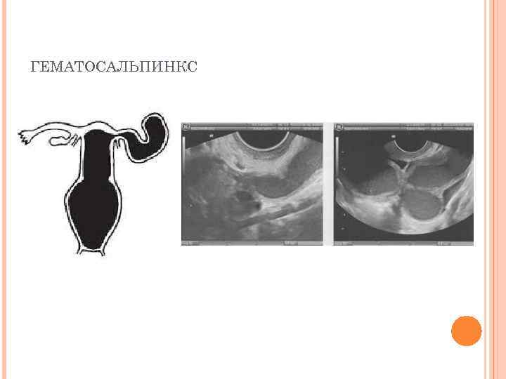 ГЕМАТОСАЛЬПИНКС 