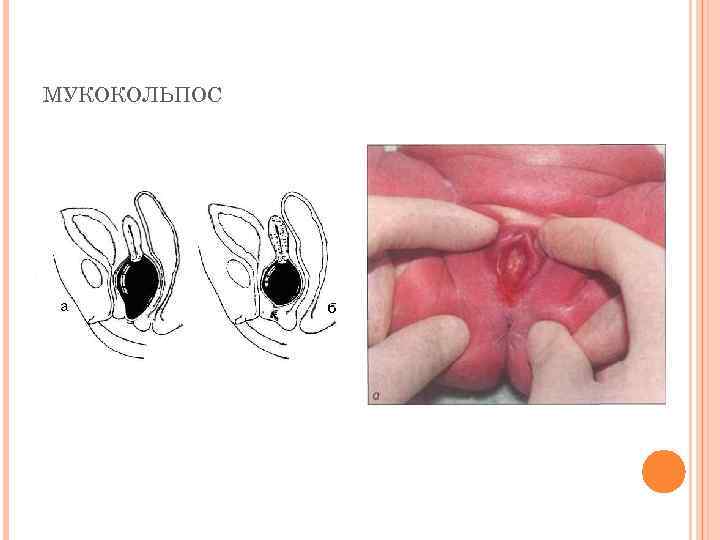 МУКОКОЛЬПОС 