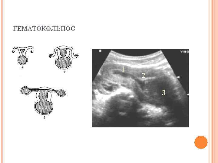 ГЕМАТОКОЛЬПОС 