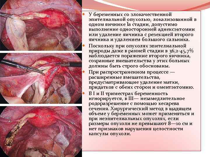  У беременных со злокачественной эпителиальной опухолью, локализованной в одном яичнике lа стадии, допустимо