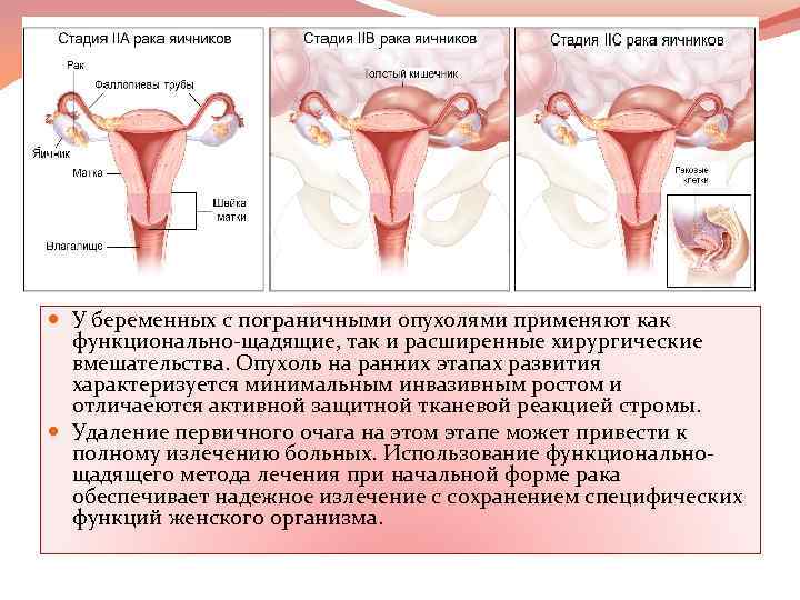  У беременных с пограничными опухолями применяют как функционально-щадящие, так и расширенные хирургические вмешательства.