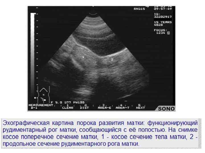 Рог матки. Рудиментарная матка на УЗИ. Рудиментарный Рог на матке на УЗИ.