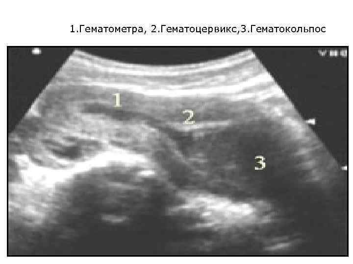 1. Гематометра, 2. Гематоцервикс, 3. Гематокольпос 