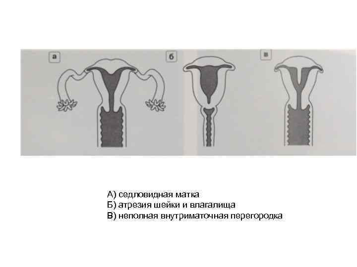 А) седловидная матка Б) атрезия шейки и влагалища В) неполная внутриматочная перегородка 